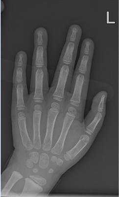 Case report: 11-ketotestosterone may potentiate advanced bone age as seen in some cases of Wiedemann-Steiner Syndrome